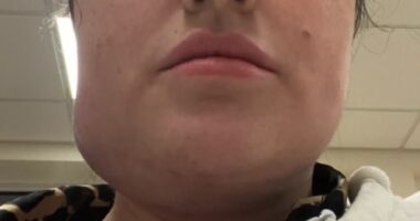 Influencer Robyn McManus pictured after her second surgery - which caused her face to swell uncontrollably as a result of a haematoma