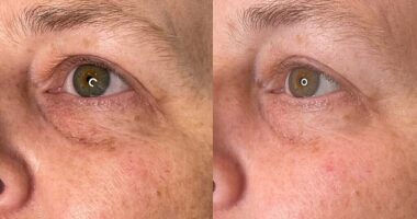 Ameela Eyes pre-treatment (left) and post-treatment (right). Treatment nationwide start from £350