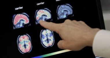 Alzheimer's Disease Found to Be Spread by Medical Procedure From Decades Ago – RedState