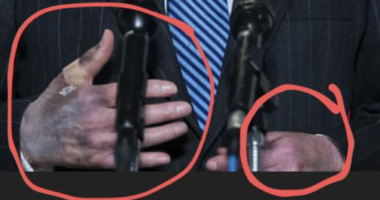 FACT-CHECK: Mitch McConnell’s Hands and Mouth Alarmingly Black and Blue?