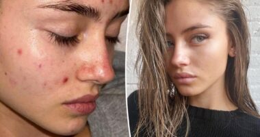 Leni Klum, 19, shares vulnerable makeup-free acne selfie