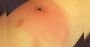 Man Dies From Rare Alaskapox Disease