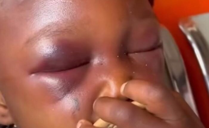 Eight year old left with swollen eyes and hands after she was assaulted by her aunt