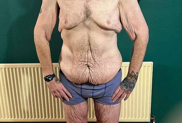Wayne Shepherd, 41, from Little Downham, Cambridgeshire, who lost a staggering 24 stone has told how he now faces paying £40,000 to have his excess skin removed because the NHS won't fund the op