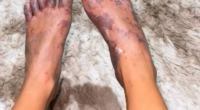 Influencer may never be able to walk again after taking part in online "challenge" that turned her feet black