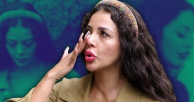 Jasmine's Alarming Before & After Photos Showing Alopecia Hair Condition