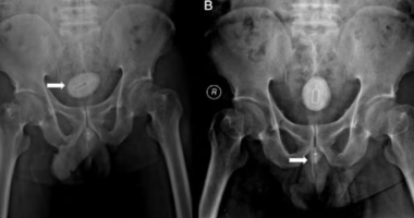 Man, 48, left in agony after sticking sim card extractor tool, electrical cable and rubber band into his penis