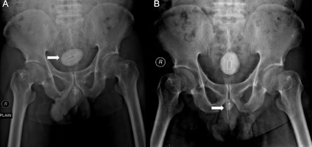 Man, 48, left in agony after sticking sim card extractor tool, electrical cable and rubber band into his penis