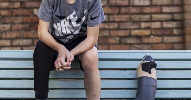 Arlo Tate's leg was amputated when he was just 18 months old - but at nine, he is a successful model