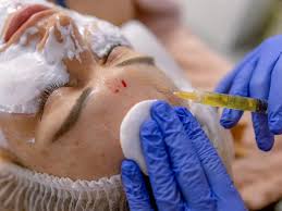 Three women diagnosed with HIV after having vampire�facials at unlicensed clinic