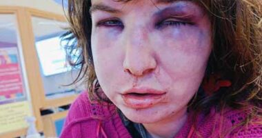 Trans woman shares horrific facial injuries following attack that saw her targeted and beaten up by a group of men on a bus