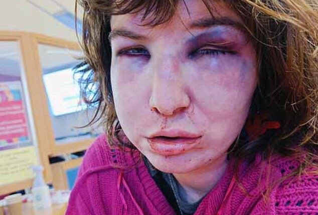 Trans woman shares horrific facial injuries following attack that saw her targeted and beaten up by a group of men on a bus