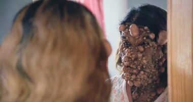 Charmaine Sahadeo from Trinidad, suffers from NF-1 neurofibromatosis, a rare condition that causes tumors to form across the body