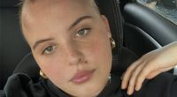 Lydia Morley (pictured) was diagnosed with alopecia areata in January this year
