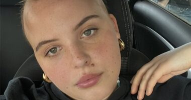 Lydia Morley (pictured) was diagnosed with alopecia areata in January this year