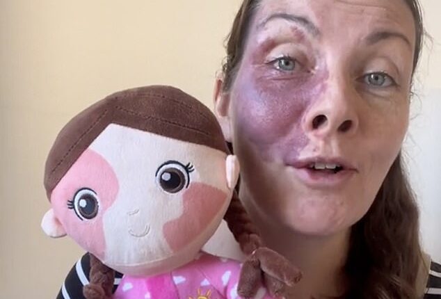 A mother-of-four from the Scottish Highlands, who goes by @frithonlife (pictured), said the Aldi toy is the first doll she's owned with a birth mark like hers