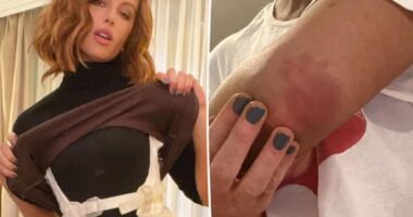 Kate Beckinsale shares photos of frightening injuries
