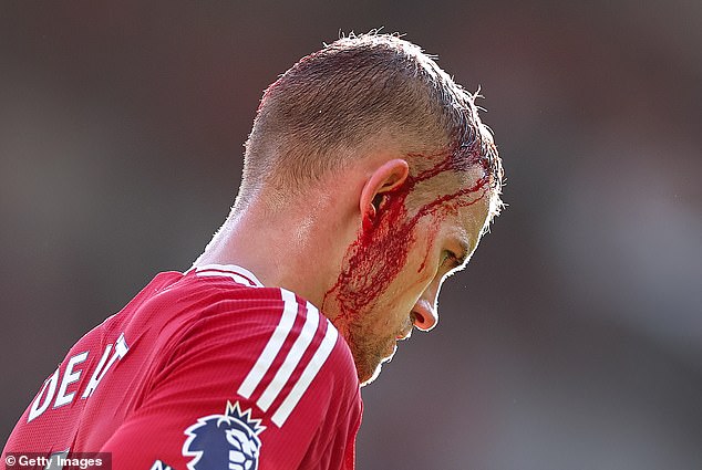 Man United defender Matthijs de Ligt suffers bloody head injury against Brentford - who score after he is ordered off the pitch for treatment
