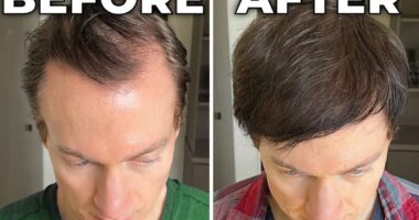 Millionaire biohacker Bryan Johnson reveals how he reversed hair loss and greying