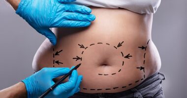 Inge says it's worth looking into AirSculpt, a keyhole-surgery lipo under local anaesthetic