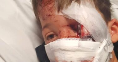 Ten-year-old Carter Ralph was left with severe facial wounds after being hit by an electric motorcycle that was being ridden on the pavement
