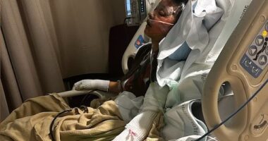 Mia Vazquez, 16, suffered burns to 'all' of her face, arms, hands, and legs when a 55-gallon fuel drum was thrown onto a beach bonfire and exploded