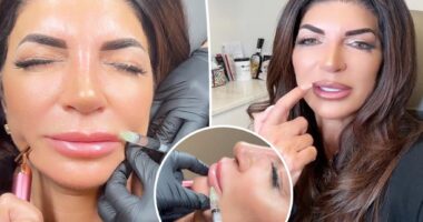 Teresa Giudice reveals she is dissolving her lip filler