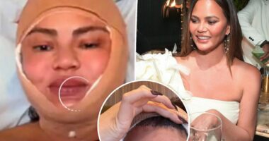 Chrissy Teigen gets hairline lowered in shocking procedure