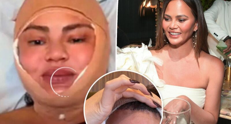 Chrissy Teigen gets hairline lowered in shocking procedure