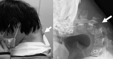 Shocking photos show a bulge erupting from his neck, which medics attributed to his vertebrae becoming 'extremely extended' from the unnatural position