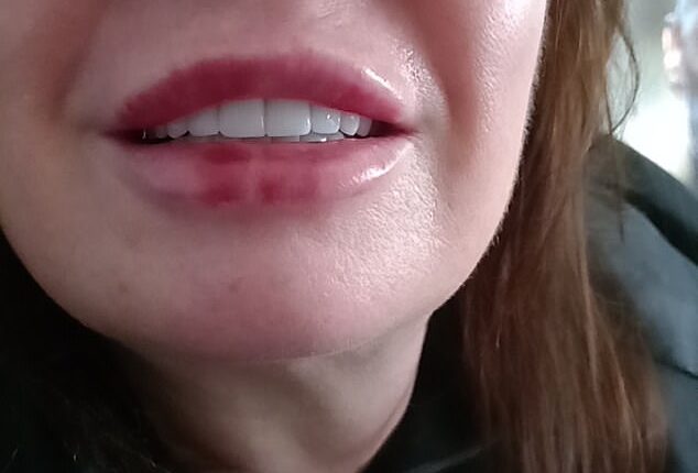 Marsha Thomas from Wrexham said she's 'drowning' in debt and in constant pain due to her botched Turkey teeth (pictured with her new teeth)
