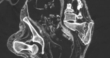 The mystery surrounding the bizarre ' alien ' mummies found in Peru has deepened after scientists said they discovered a fetus inside the womb of one of the 'corpses'. CT scans (pictured) captured the fetus lying on its back