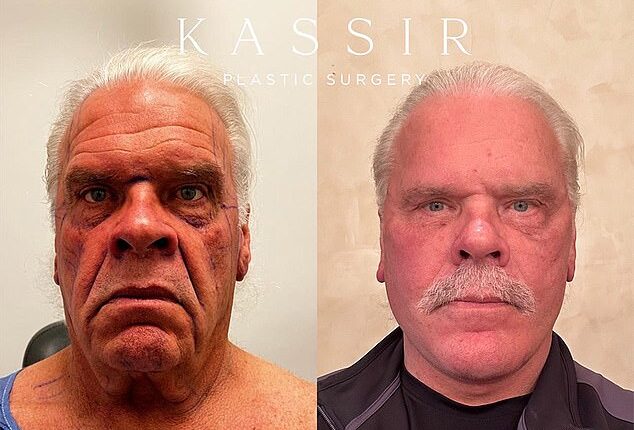 A 70-year-old man seems to have reversed time after a series of surgeries took decades off his face
