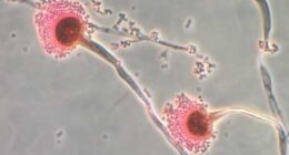 Aspergillus fungus is a toxic fungus that kills up to 50 percent of patients. But researchers have found some forms of it may help treat leukemia