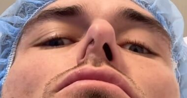 Timm Hanly (pictured) has undergone surgery after his septum completely collapsed