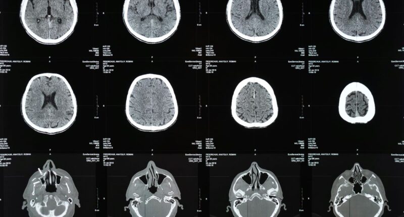 brain scan