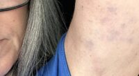 A darts fan has revealed bruising she claims was inflicted by security when she was kicked out of an event in Blackpool for protesting a transgender player