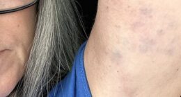 A darts fan has revealed bruising she claims was inflicted by security when she was kicked out of an event in Blackpool for protesting a transgender player