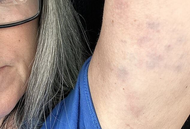 A darts fan has revealed bruising she claims was inflicted by security when she was kicked out of an event in Blackpool for protesting a transgender player