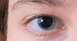 The young woman uploaded a picture to the 'Eyes' subreddit under the heading 'Why are my eyes so dilated?'