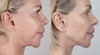 Leslie Ash, 65, has opened up about doing a £4,500 non-surgical face-lift that made her look 'ten years younger'