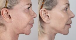 Leslie Ash, 65, has opened up about doing a £4,500 non-surgical face-lift that made her look 'ten years younger'
