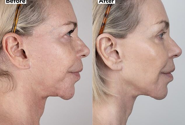 Leslie Ash, 65, has opened up about doing a £4,500 non-surgical face-lift that made her look 'ten years younger'