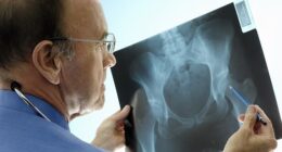 More than 100 leading NHS doctors have warned Health Secretary Wes Streeting that failing to honour his pre-Election commitment to urgently rollout screening clinics for osteoporosis risks causing thousands of preventable deaths (stock image)
