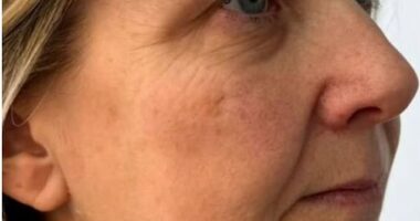 Before: A jowl lift at Lindsey Anne Beauty and Cosmetics in Penkridge