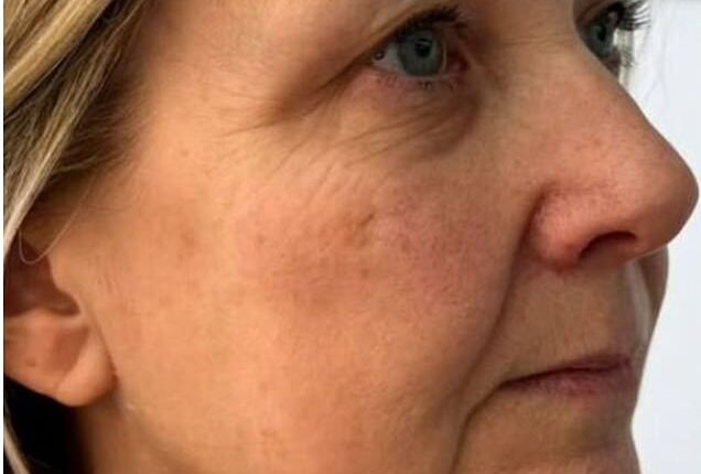 Before: A jowl lift at Lindsey Anne Beauty and Cosmetics in Penkridge