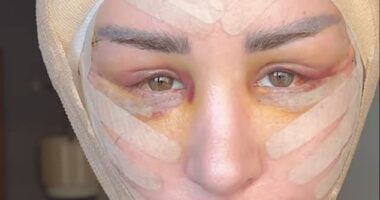 90 Day Fiancé star Shekinah Garner (pictured) underwent a Firat facelift, and showed the aftermath of the surgery to her followers