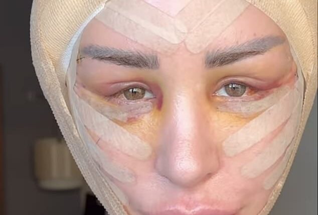 90 Day Fiancé star Shekinah Garner (pictured) underwent a Firat facelift, and showed the aftermath of the surgery to her followers