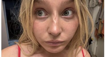 On Reddit, the young woman took to the popular 'plastic surgery' thread to share a picture of her misshaped facial feature