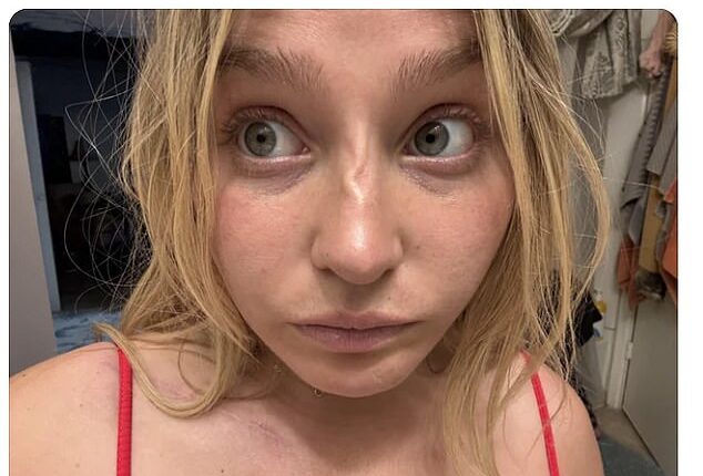 On Reddit, the young woman took to the popular 'plastic surgery' thread to share a picture of her misshaped facial feature
